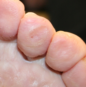 Corn after Chiropody Treatment