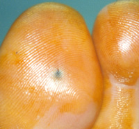 Foreign Body in Toe