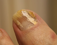 Fungal Nail Infection - Before Treatment