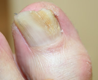 Fungal Toenail Infection - During Treatment with Nail Mycosis Solution