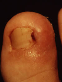 Ingrowing toenail showing swelling and redness