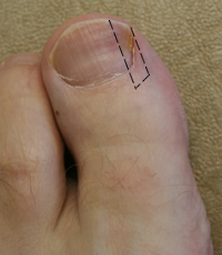Nail wedge to be removed