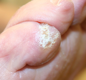 Corn immediately to the side of a toenail 