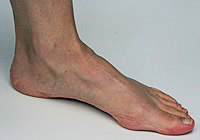 Normal arch in foot