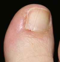 Partial Nail Avulsion Day 18