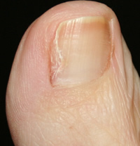 Partial Nail Avulsion - Month 3