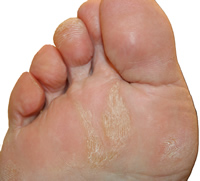 Plantar foot callus