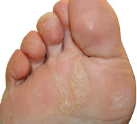 Plantar Fasciitis,Pes Planus,Mallet Toe,High Arched Feet,Heel Spur,Heel Pain,Hammer Toe,Hallux Valgus,Foot Pain,Foot Hard Skin,Foot Conditions,Foot Callous,Flat Feet,Fallen Arches,Diabetic Foot,Contracted Toe,Claw Toe,Bunions Hard Skin,Bunions Callous,Bunion Pain,Ball Of Foot Pain,Back Pain