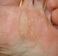 foot callus peel