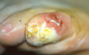 Patient's own treatment with salicylic acid has made the little toe extremely painful 