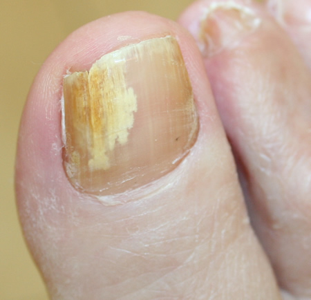 FUngal Nail Infection