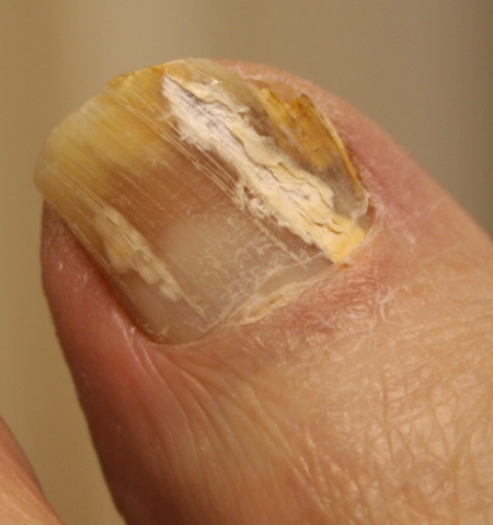 Fungal Nail Infection