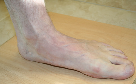 Adult Acquired Flat Feet