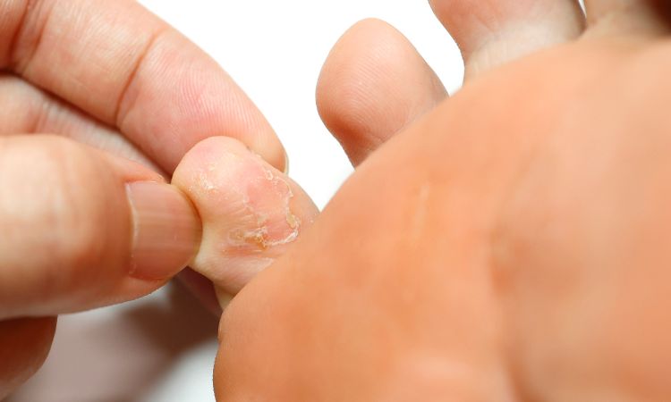 Illustration photo of athlete’s foot between toes