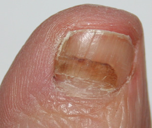 Bruised toenail - close up