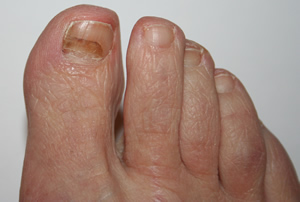Bruised toenail