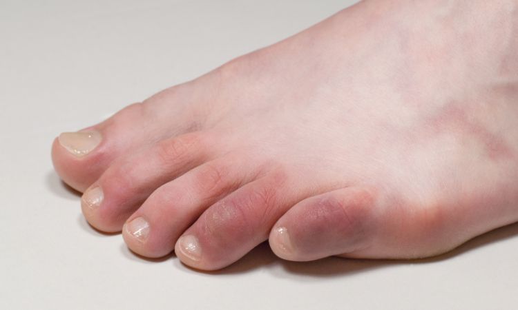 Illustration photo of chilblains on toes