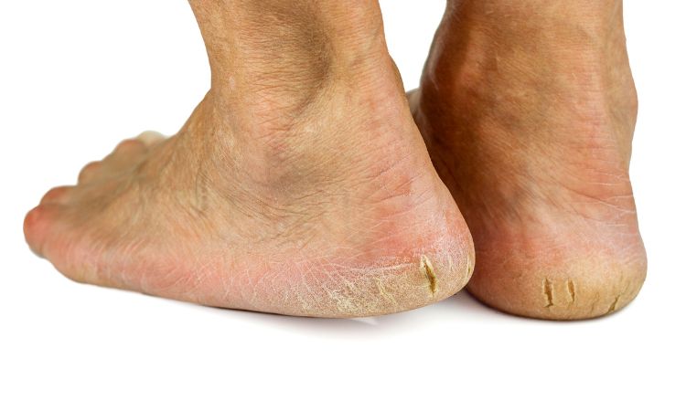 Illustration photo of cracked heels