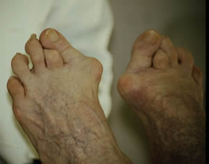 Deformed toes - overlapping, hallux valgus, claw toes 