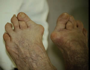 Deformed toes - overlapping, hallux valgus, claw toes