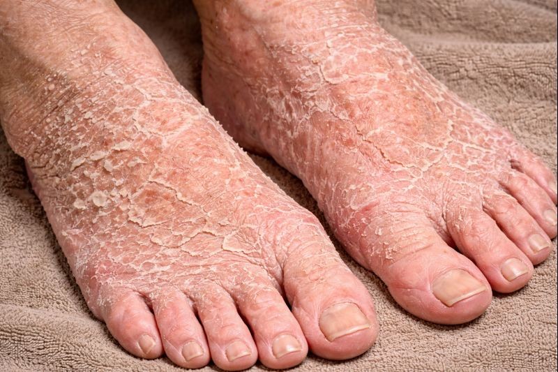 Illustration photo of dry skin on the feet