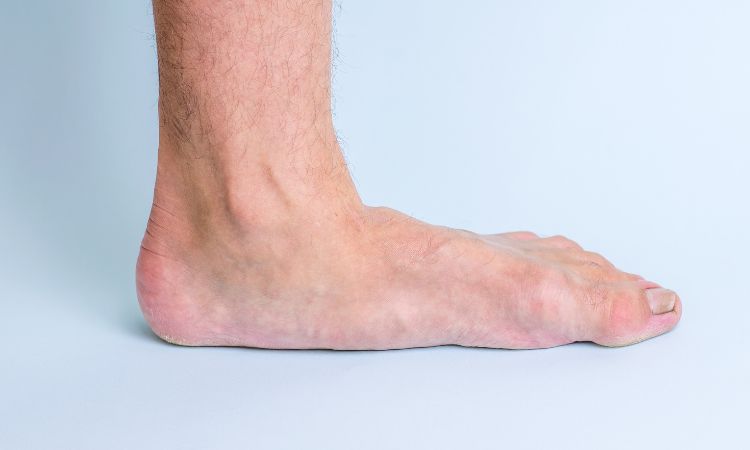 Illustration photo showing flat feet