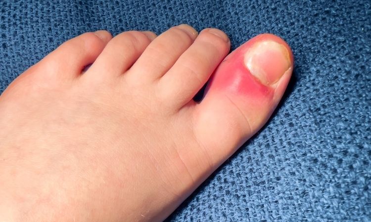 Illustration photo showing a red, swollen area of skin on the foot suggesting infection
