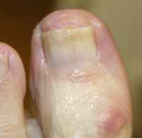 Fungal Toenail Infection - During Treatment with Nail Mycosis Solution
