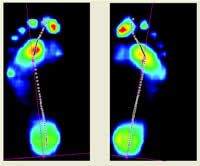 Gaitscan - Dynamic 2D Measurement