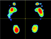 The red colour shows areas of high pressure on the feet