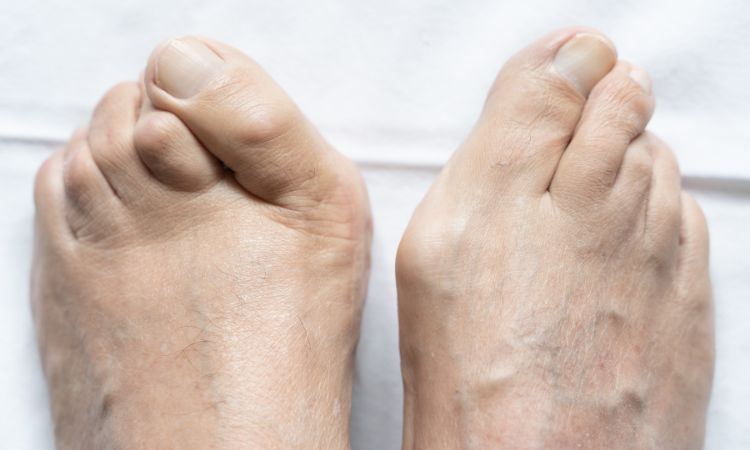 Illustration photo of hallux valgus or a bunion