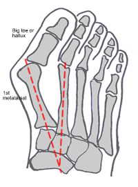 Hallux Valgus and Bunion