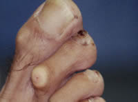 Hammer toe