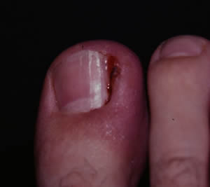 Ingrown toe nail