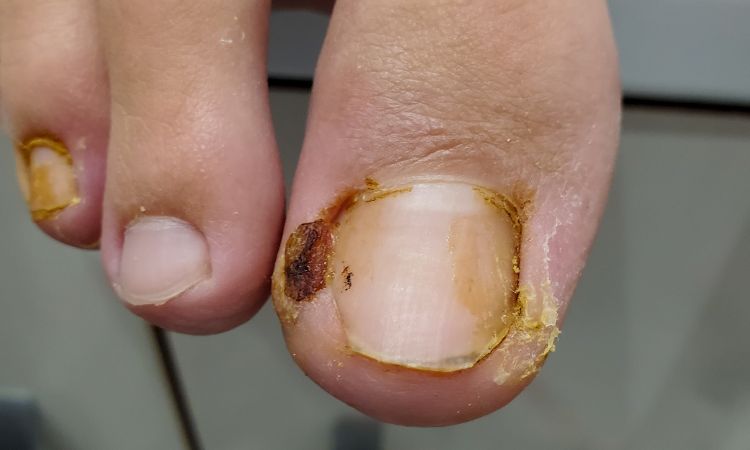 Illustration photo of an ingrowing toenail