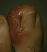 Ingrown toenail showing swelling and redness