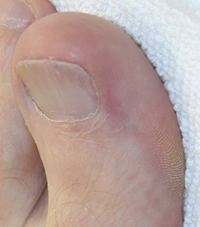 Ingrowing toenail several weeks after nail surgery