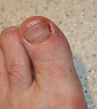 Ingrowing toenail just after nail surgery