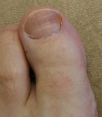 Ingrowing Toenail before nail surgery