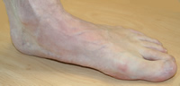 Left Foot Medial Aspect