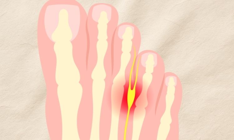 Illustration photo indicating pain in the ball of the foot between toes