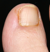 Partial Nail Avulsion Day 12