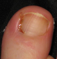 Partial Nail Avulsion Day 8