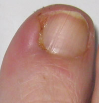 Partial Nail Avulsion Day 9 