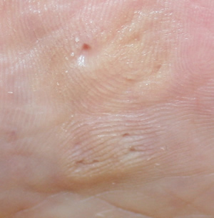 Plantar Callus after Chiropody Treatment - close up