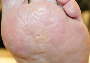 Plantar Callus - After Treatment