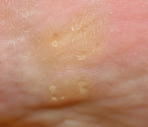 Plantar callus before Chiropody Treatment - close up