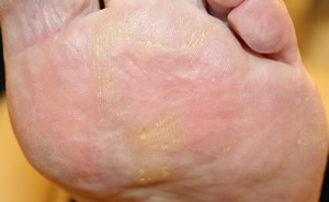 Plantar Callus - Before Treatment