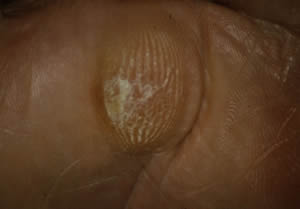 Plantar Callus