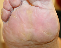 Plantar Callus and Corns